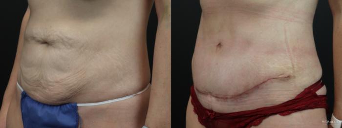 Before & After Tummy Tuck Case 262 Left Oblique View in St. Louis, MO