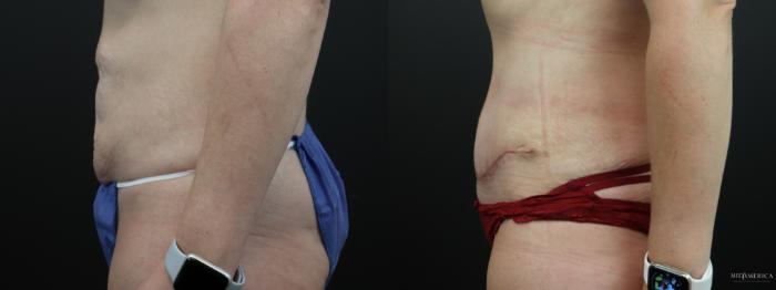 Before & After Tummy Tuck Case 262 Left Side View in St. Louis, MO