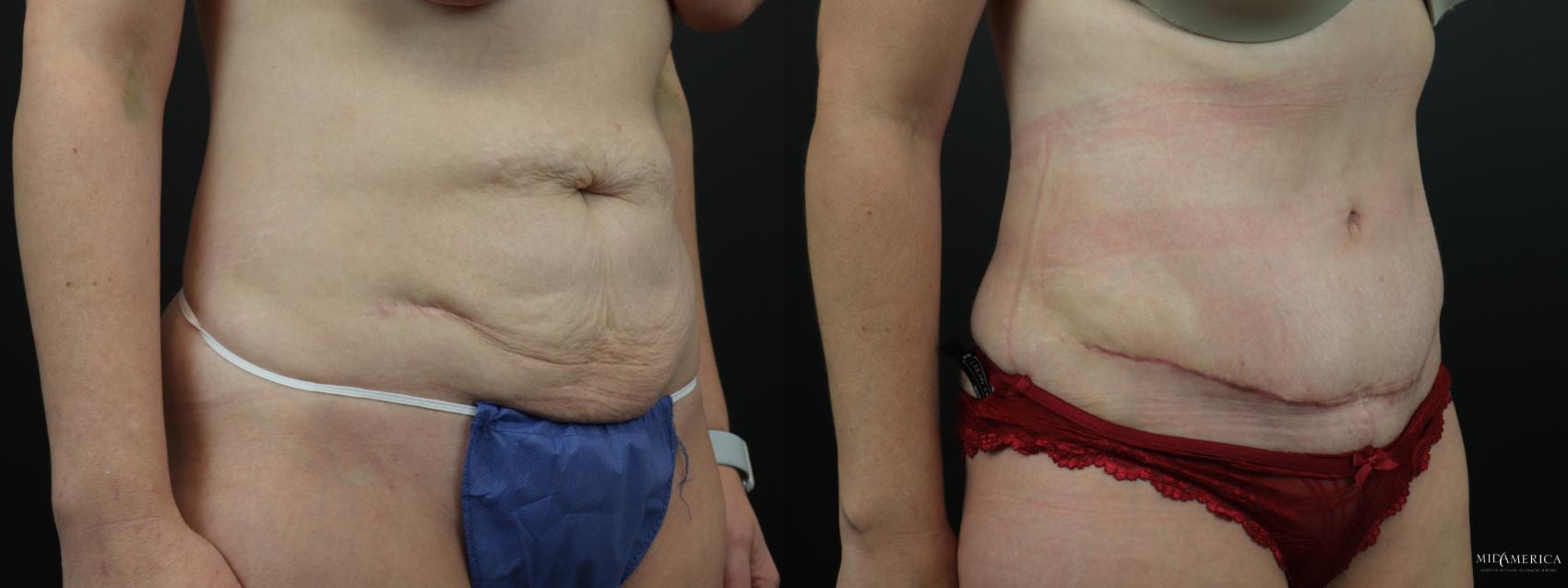 Before & After Tummy Tuck Case 262 Right Oblique View in Glen Carbon, IL