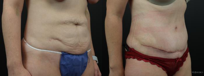 Before & After Tummy Tuck Case 262 Right Oblique View in St. Louis, MO