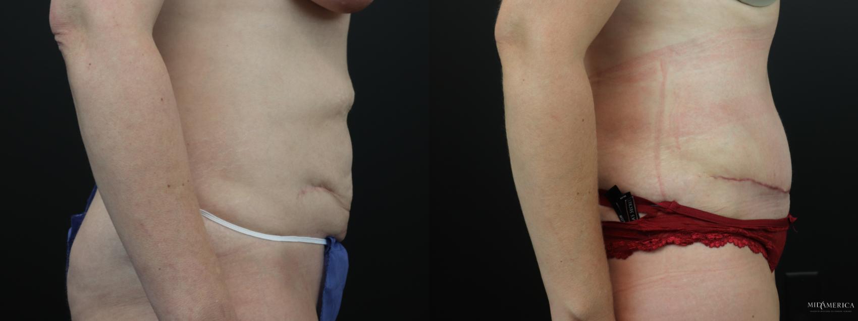 Before & After Tummy Tuck Case 262 Right Side View in Glen Carbon, IL
