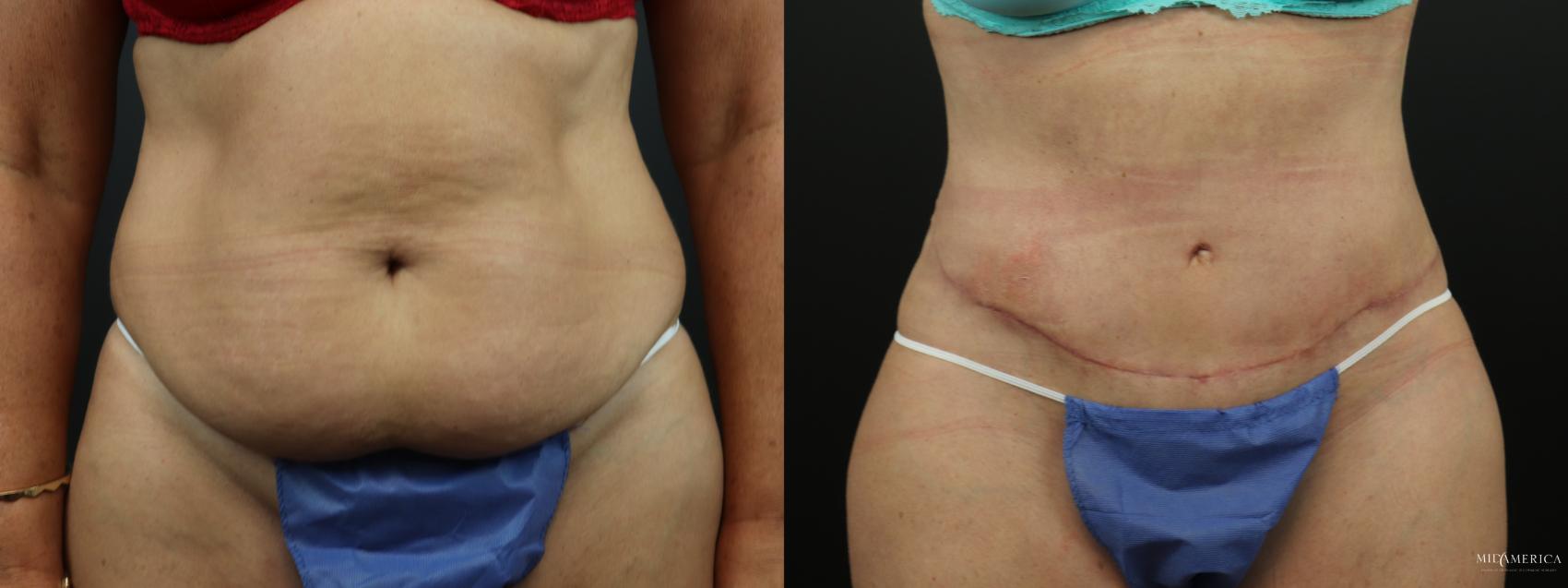 Before & After Tummy Tuck Case 289 Front View in Glen Carbon, IL
