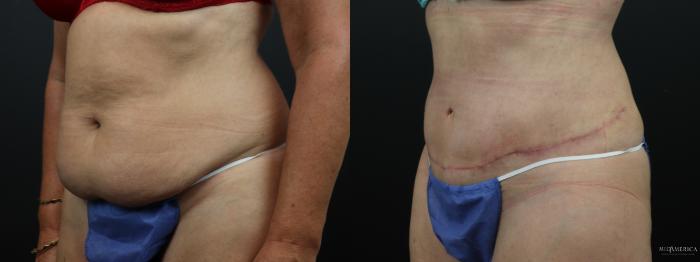 Before & After Tummy Tuck Case 289 Left Oblique View in Glen Carbon, IL