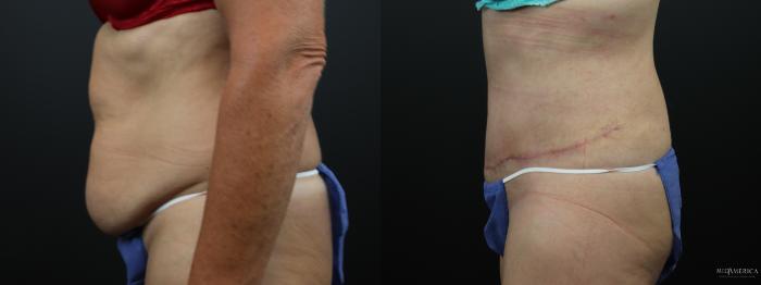 Before & After Tummy Tuck Case 289 Left Side View in Glen Carbon, IL
