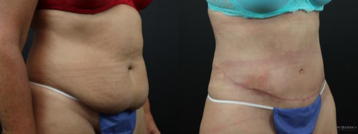 Before & After Tummy Tuck Case 289 Right Oblique View in Glen Carbon, IL
