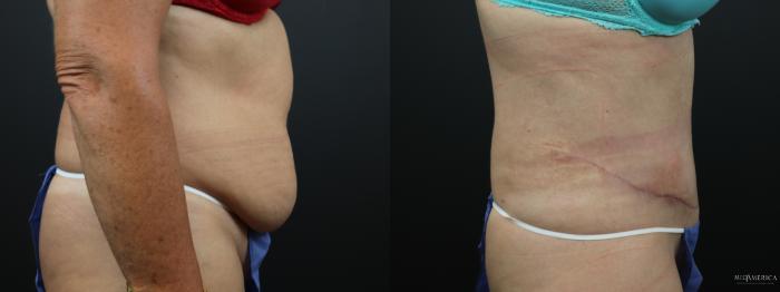Before & After Tummy Tuck Case 289 Right Side View in Glen Carbon, IL