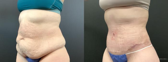 Before & After Tummy Tuck Case 290 Left Oblique View in St. Louis, MO