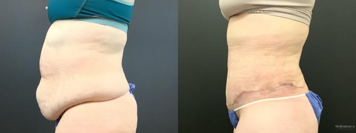 Before & After Tummy Tuck Case 290 Left Side View in St. Louis, MO