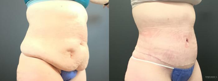 Before & After Tummy Tuck Case 290 Right Oblique View in St. Louis, MO