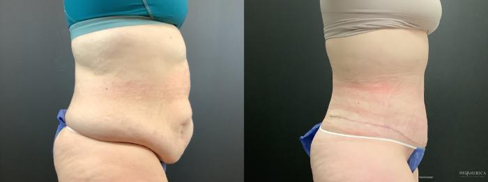 Before & After Tummy Tuck Case 290 Right Side View in St. Louis, MO