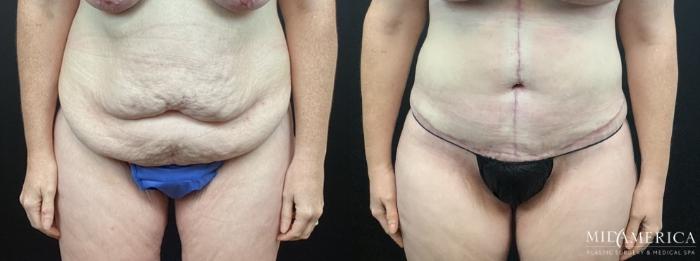 Before & After Tummy Tuck Case 322 Front View in St. Louis, MO