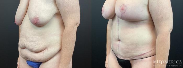 Before & After Tummy Tuck Case 322 Left Oblique View in St. Louis, MO