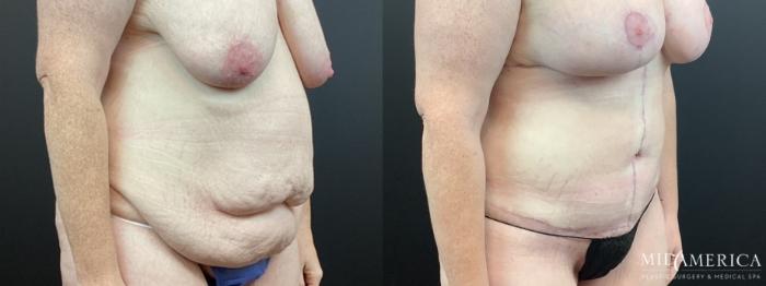 Before & After Tummy Tuck Case 322 Right Oblique View in St. Louis, MO