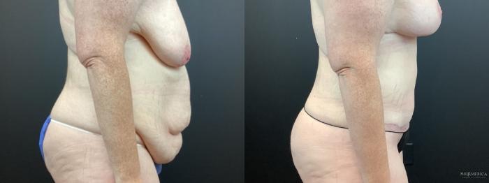 Before & After Tummy Tuck Case 322 Right Side View in St. Louis, MO