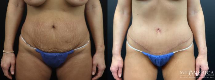 Before & After Tummy Tuck Case 323 Front View in St. Louis, MO
