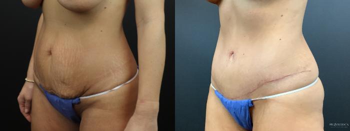 Before & After Tummy Tuck Case 323 Left Oblique View in St. Louis, MO