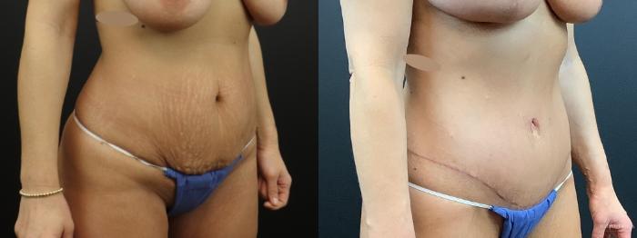 Before & After Tummy Tuck Case 323 Right Oblique View in St. Louis, MO