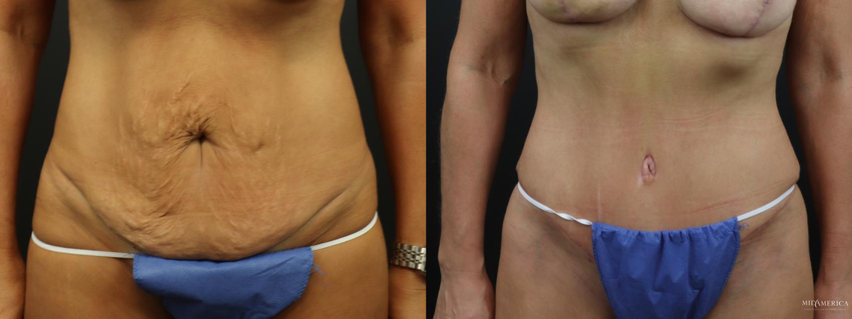 Before & After Tummy Tuck Case 324 Front View in St. Louis, MO