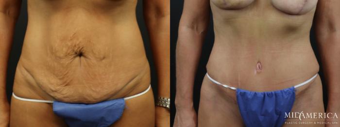 Before & After Tummy Tuck Case 324 Front View in St. Louis, MO