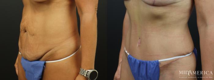 Before & After Tummy Tuck Case 324 Left Oblique View in St. Louis, MO