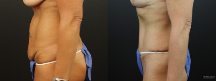 Before & After Tummy Tuck Case 324 Left Side View in St. Louis, MO