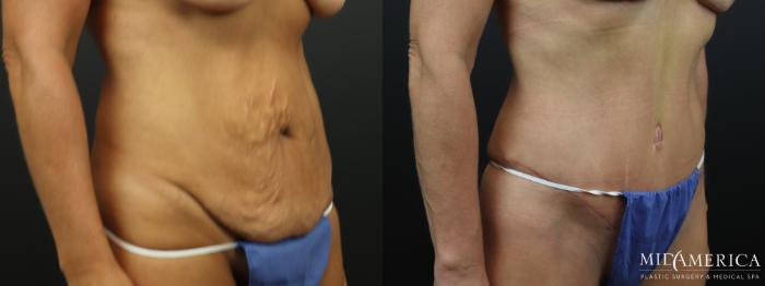 Before & After Tummy Tuck Case 324 Right Oblique View in St. Louis, MO
