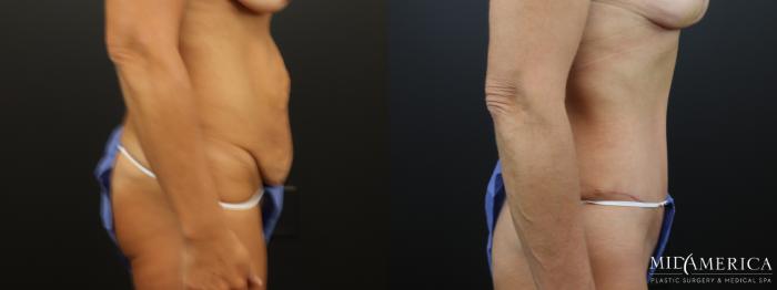 Before & After Tummy Tuck Case 324 Right Side View in St. Louis, MO