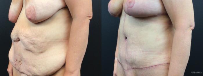 Before & After Tummy Tuck Case 326 Left Oblique View in St. Louis, MO