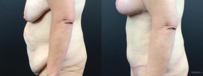 Before & After Tummy Tuck Case 326 Left Side View in St. Louis, MO
