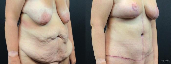 Before & After Tummy Tuck Case 326 Right Oblique View in St. Louis, MO