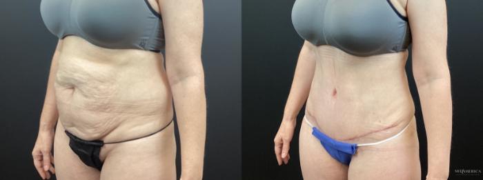 Before & After Tummy Tuck Case 334 Left Oblique View in St. Louis, MO