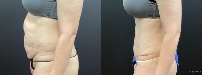 Before & After Tummy Tuck Case 334 Left Side View in St. Louis, MO