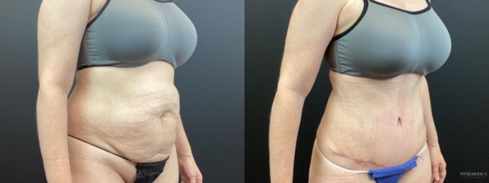 Before & After Tummy Tuck Case 334 Right Oblique View in St. Louis, MO