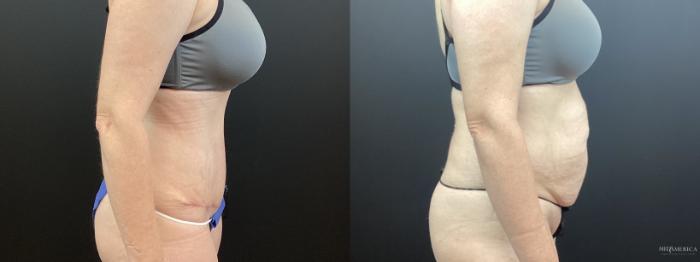 Before & After Tummy Tuck Case 334 Right Side View in St. Louis, MO
