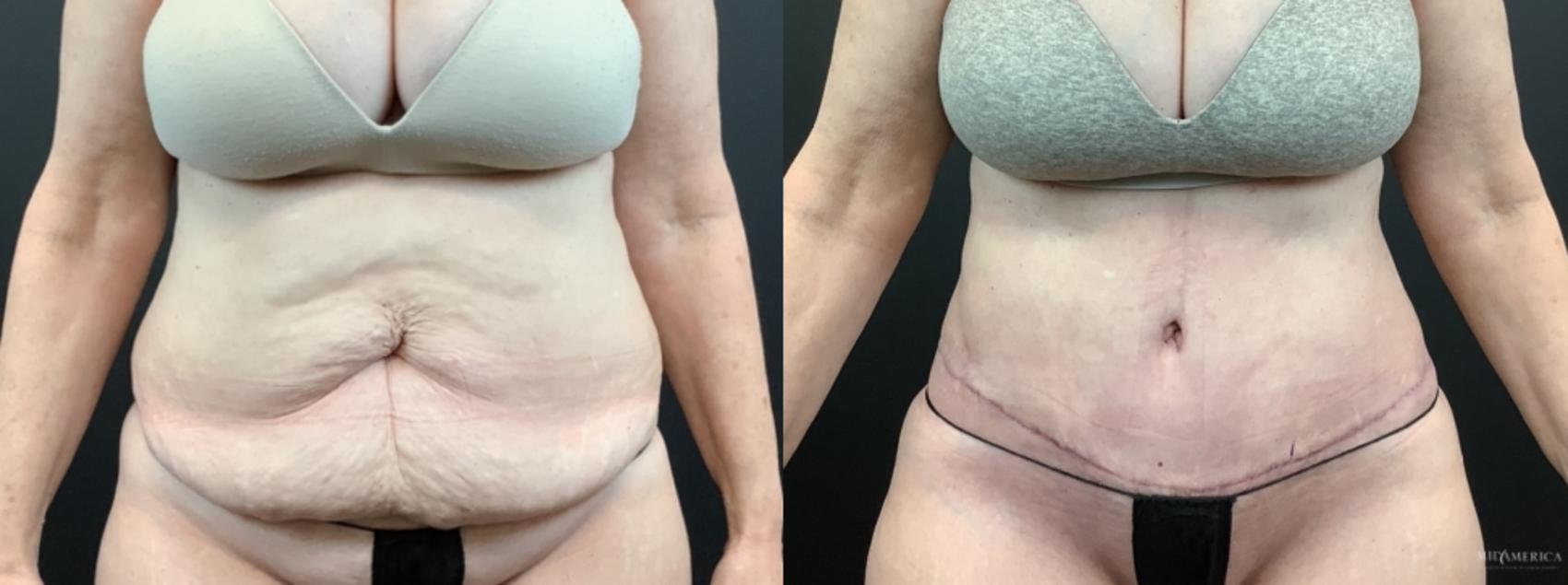Before & After Tummy Tuck Case 336 Front View in St. Louis, MO