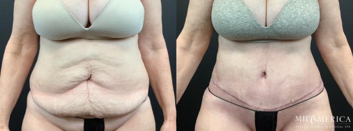Before & After Tummy Tuck Case 336 Front View in St. Louis, MO