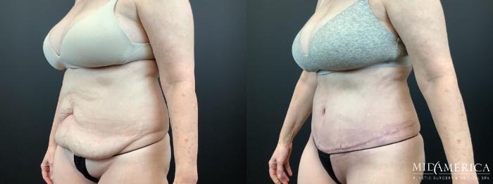 Before & After Tummy Tuck Case 336 Left Oblique View in St. Louis, MO