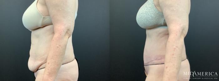 Before & After Tummy Tuck Case 336 Left Side View in St. Louis, MO