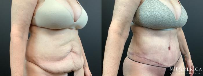 Before & After Tummy Tuck Case 336 Right Oblique View in St. Louis, MO