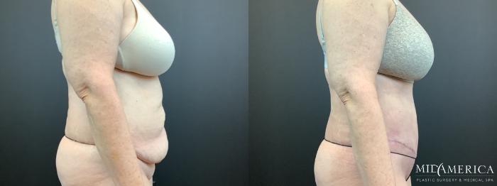 Before & After Tummy Tuck Case 336 Right Side View in St. Louis, MO