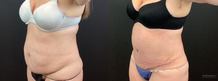 Before & After Tummy Tuck Case 339 Left Oblique View in St. Louis, MO