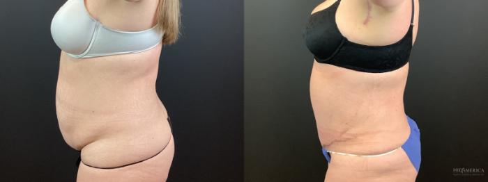 Before & After Tummy Tuck Case 339 Left Side View in St. Louis, MO