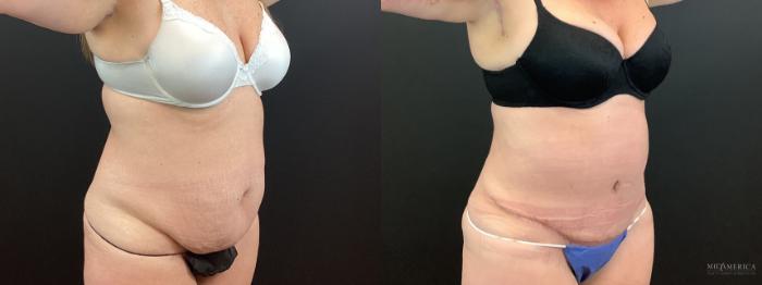 Before & After Tummy Tuck Case 339 Right Oblique View in St. Louis, MO