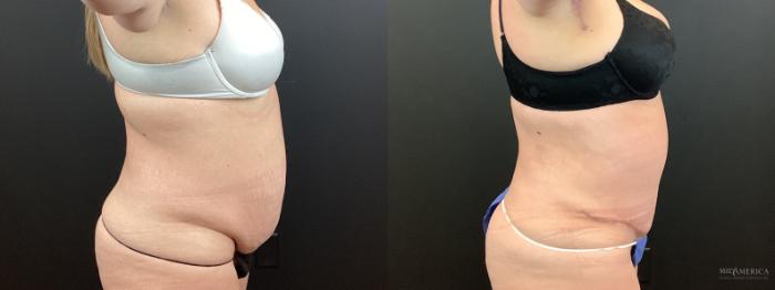 Before & After Tummy Tuck Case 339 Right Side View in St. Louis, MO