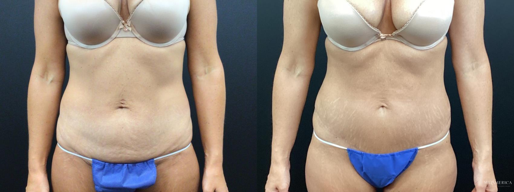 Before & After Tummy Tuck Case 344 Front View in St. Louis, MO