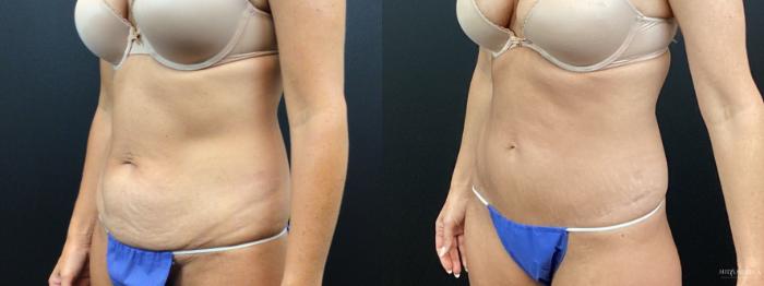 Before & After Tummy Tuck Case 344 Left Oblique View in St. Louis, MO