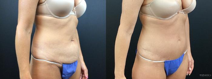 Before & After Tummy Tuck Case 344 Right Oblique View in St. Louis, MO
