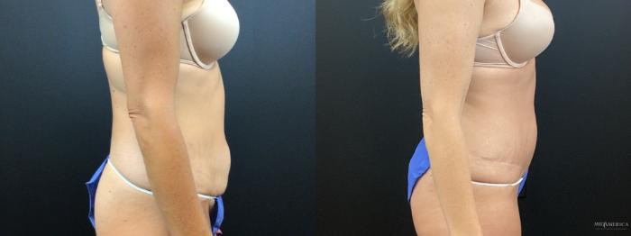 Before & After Tummy Tuck Case 344 Right Side View in St. Louis, MO