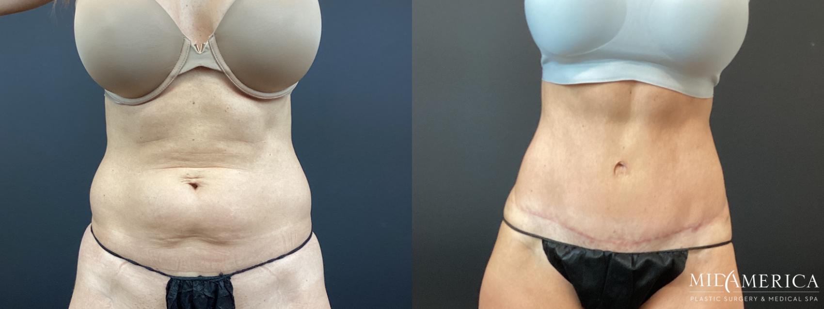 Before & After Tummy Tuck Case 347 Front View in St. Louis, MO
