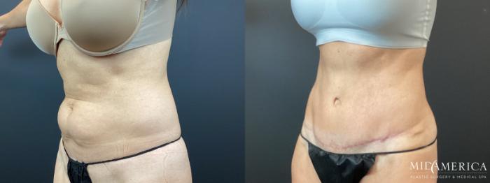 Before & After Tummy Tuck Case 347 Left Oblique View in St. Louis, MO